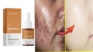 hyperpigmentation serum  daag dhabbe hataye dermatouch serum [upl. by Nottirb885]