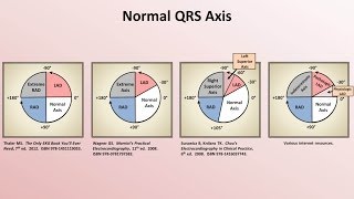 Intro to EKG Interpretation  Rate and Axis [upl. by Jacie99]