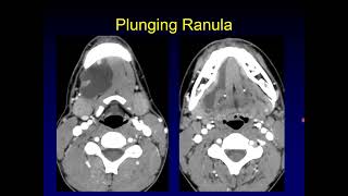 Its Not a Ranula [upl. by Ahsitra]