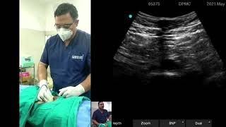 SONOANATOMY OF SHPB SUPERIOR HYPOGASTRIC PLEXUS BLOCK [upl. by Valenza]