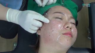 Non surgical Full Facelift PDO thread technique  NCog amp NScaffold [upl. by Olen371]