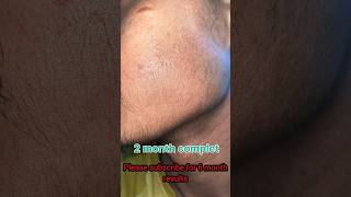 Mintop minoxidil 2 month beard growth results  minoxidil [upl. by Athena]