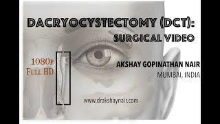 Dacryocystectomy  DCT Lacrimal Mucocele  surgical video Full HD [upl. by Daphie319]