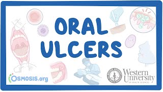 Western University  Oral Ulcers [upl. by Cleaves]