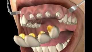 What is a Dental Bridge [upl. by Atnahsa]