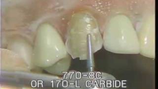 Maxillary Cuspid Preparation for a Porcelain Fused to Gold Crown [upl. by Trammel]