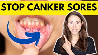 9 Tips To Prevent Canker Sores [upl. by Allison]