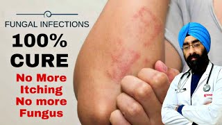 Best Treatment of Fungal Skin Infections  Expert Advice  DrEducation ENG [upl. by Frederiksen]