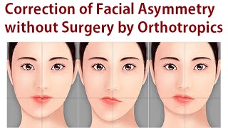 Correction of Facial Asymmetry Without Oral Surgery Using Orthotropics Method By Dr Mike Mew [upl. by Namolos244]