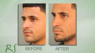 Rhinoplasty Experience of Dr Nassifs Patient Max [upl. by Honniball]