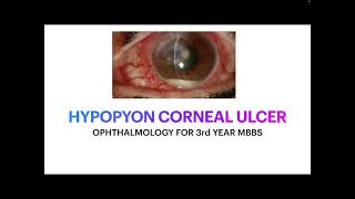 Hypopyon corneal ulcer for 3rd year MBBS students [upl. by Aynad]