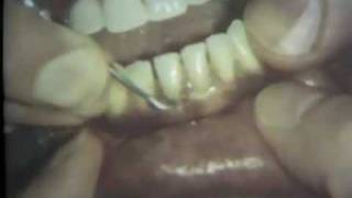 Scaling and Root Planing Part II Mandibular Teeth [upl. by Basil]