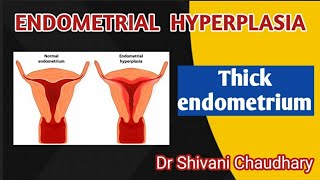 Endometrial hyperplasia  Thick endometrium heavybleeding uterus [upl. by Sothena]