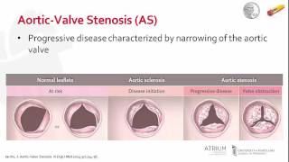 Pathophysiology of AorticValve Stenosis [upl. by Eenaj332]