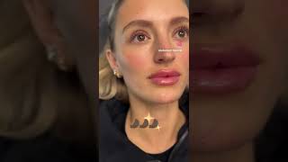 Facial Balancing with one syringe of filler chinfiller lipfiller injector [upl. by Naesad526]