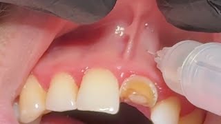 Local Anesthesia For Extraction Upper Central incisor  anterior superior and nasopalatine nerve [upl. by Karylin]