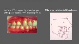 Treatment and stability of Class II Division 2 malocclusion in children and adolescents [upl. by Miah129]