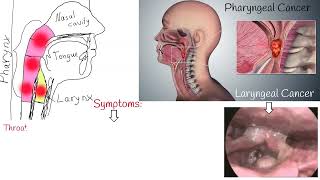 Throat cancer  Symptoms causes and Treatment Laryngeal Cancer and Pharyngeal Cancer [upl. by Gapin]