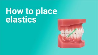 How to Place Elastics with Clear Aligners 9 Ortho Pro techniques [upl. by Trask]