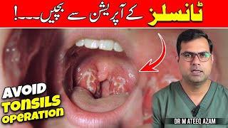 The 1 Best method to treat Tonsillitis [upl. by Sevy]