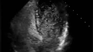 Bubble study on echo  PFO  The Echo Clip [upl. by Marcellus]