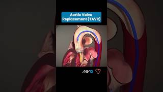 🫀Transcatheter Aortic Valve Replacement TAVR 🫀 [upl. by Sidnac]