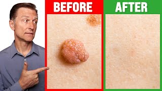 How to Rid Skin Tags and Warts Within 24 Hours  Dr Berg on Skin Tag Removal [upl. by Fielding]