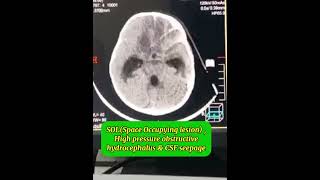 Posterior fossa SOL Brain tumor CT scan High pressure obstructive non communicating hydrocephalus [upl. by Sidonius916]