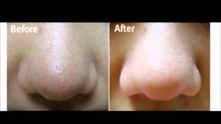 Black head Removal Before amp After Results [upl. by Cherilynn]