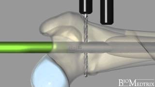 ILoc® IM Fixator Interlocking Nail  BioMedtrix [upl. by Faxen]