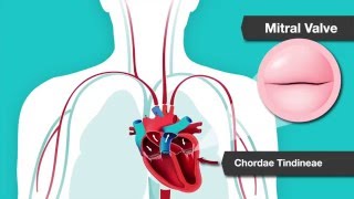 Understanding Heart Murmurs Aortic and Mitral Valve Problems [upl. by Aramad]