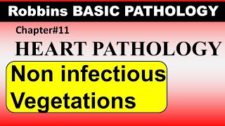 Chp11 Robbins Patho  Heart Pathology  Noninfectious Vegetations  Libman Sick  Dr Asif Lectures [upl. by Acebber]