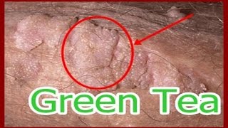 How to Cure Genital Warts Naturally Using Green Tea [upl. by Aubreir]