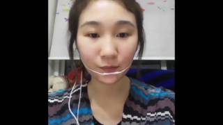 China Pre and Postop video of voice PDL Surgery [upl. by Kentigerma]