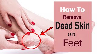 How to Remove Dead Skin on Your Feet at Home  Home Remedies for Dead Skin Removal on Feet [upl. by Adnek324]