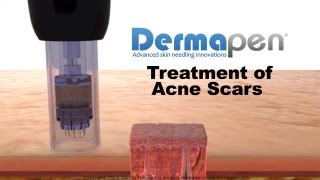 MicroNeedling for Acne Scars  Dermapen® Treatment [upl. by Acinimod980]