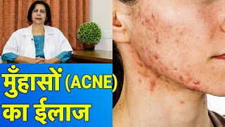 एक्जिमा ट्रीटमेंट Treatment  How to get rid of Eczema  Sakhiya Skin Clinic  Dr Jagdish Sakhiya [upl. by Sivrep]