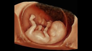 How to Perform 3D Scan of the Baby at 12 Weeks of Pregnancy [upl. by Eelinnej]