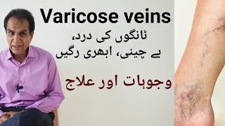 Varicose veins Causes precautions and treatment  ٹانگوں کی رگھوں کے ابھار کا علاج [upl. by Ahtreb]