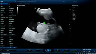 Achondroplasia associated with Hydrocephalus  Diagnostic ultrasound cases [upl. by Bopp]