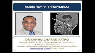 EPENDYMOMA RADIOLOGY [upl. by Ferwerda]