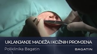 Uklanjanje madeža u Poliklinici Bagatin [upl. by Ellah]