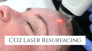 CO2 Laser Facial Rejuvenation  Fix Fine Lines and Wrinkles  Fix Sun Damage  Fix Stretch Marks [upl. by Pitts]