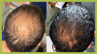 RECUPERA su CABELLO en 5 MESES SIN TRASPLANTE CAPILAR [upl. by Ruffin]