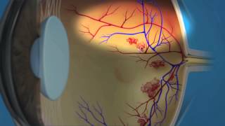 Proliferative Diabetic Retinopathy [upl. by Ahsienod838]