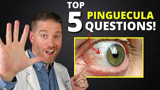 Yellow Spot On Your Eye Pinguecula  Top 5 Questions Answered [upl. by Ymar]