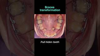 Braces transformation Hiden teeth not problem braces orthodontist dentist dental [upl. by Bohi840]