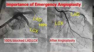 Emergency Angioplasty of 100 Blocked LAD LCX l Stenting of LAD LCX l Hindi [upl. by Nitsa991]