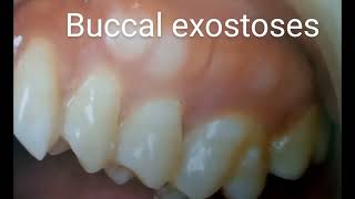 Buccal exostoses [upl. by Ikkin]