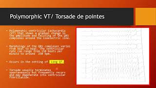 Polymorphic VT I R ON T Phenomenon I Torsade de pointes I Long QT [upl. by Aerdnaek]